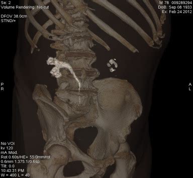 3D Reconstruction From An Abdominal And Pelvic CT Scan Without Contrast