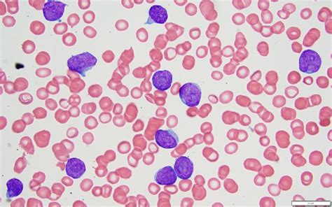 Leucemia linfoblástica aguda de células T LLA T MyPathologyReport ca