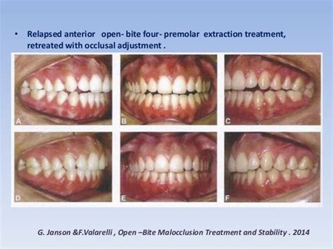 Anterior open bite treatment permanent dentition -1- .slide