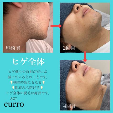 ヒゲ脱毛の実績 Act Curro（アクト クロ）