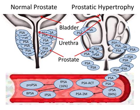 Prostate Cancer Detection Complexities And Strategies