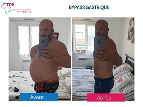 Bypass Gastrique Proc Dure Avantages Et Risques