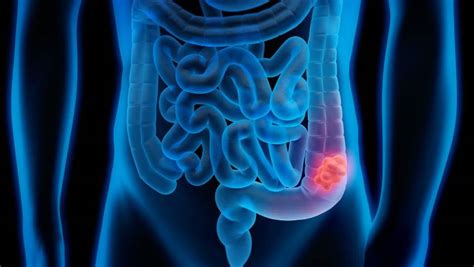 Understanding Colorectal Cancer Risk Factors And Prevention Strategies