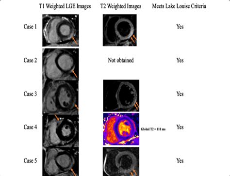 Cardiovascular Magnetic Resonance Cmr Findings Late Gadolinium