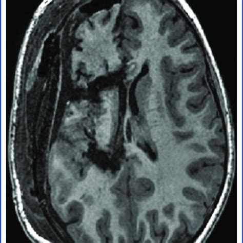 Localization of language cortices in relation to the brain lesion in a... | Download Scientific ...