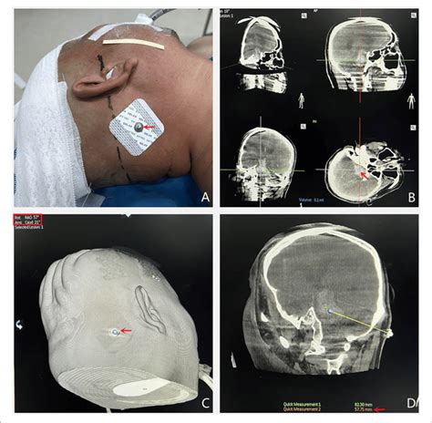 A The Percutaneous Puncture Point Was Marked With Electrode Pastes Download Scientific