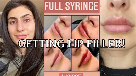 I Got Lip Filler Before After And Healing Process Restylane Kysse Lip Filler Youtube