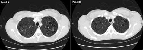 Differentiating Pulmonary Lymphangioleiomyomatosis From Pulmonary