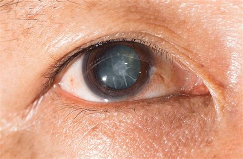 Traumatic Cataract Meaning Types Causes And Treatment