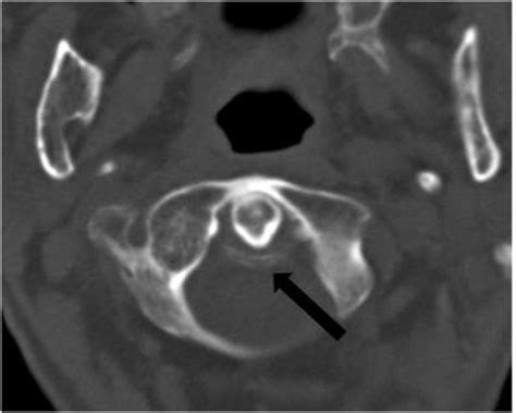 Image 44 Isolated Posterior Arch Fracture Of C1 Spinous Process