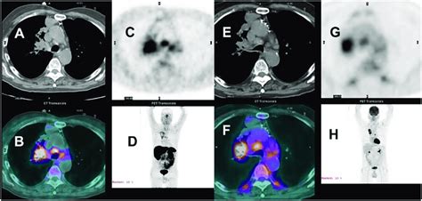 68 Ga DOTATATE A D And 18 FDG PET CT E H Concordant Staging Stage