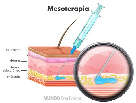 Mesoterapia O Que é Resultados Cuidados E Dicas Mundoboaforma