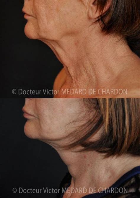 Photos avant après de lifting du visage Dr Medard de Chardon