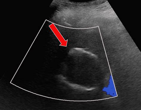 Ultrasound With Color Doppler Along The Hepatic Dome Demonstrates A Download Scientific Diagram