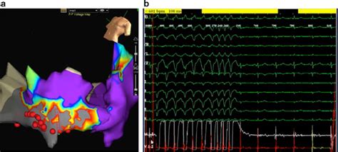 A Electroanatomical Map From Case 2 After Ablation Sites Where RF