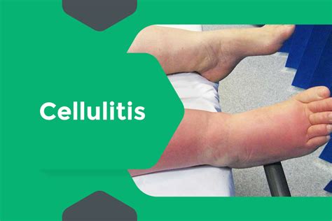 Expert Diagnosis And Treatment For Cellulitis In Surat