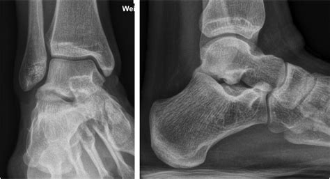 Subtalar Osteochondral Lesions Foot And Ankle Clinics