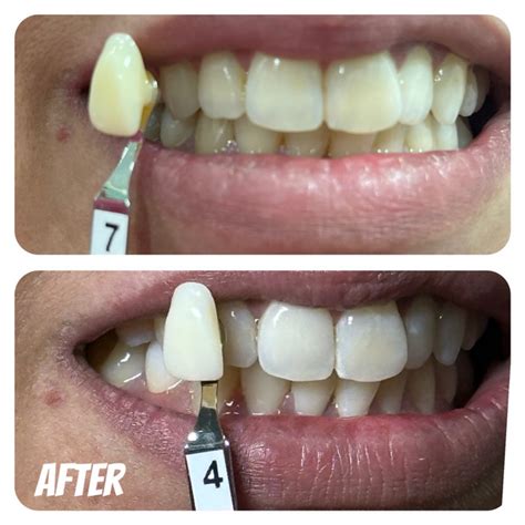 DaVinci Teeth Whitening UpLift Spa