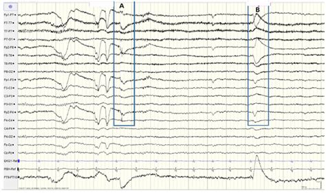 Image Of EEG By Eye Movements A Looking At The Left Side B Looking