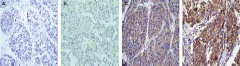 Expression Of Dcr3 Protein In Hepatocellular Carcinoma Tissues Dcr3