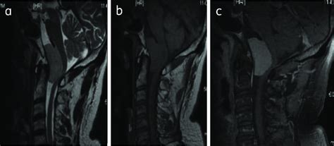 Clival Meningioma Sagittal T2wi A T1wi B And Post Contrast T1w