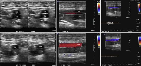 Duplex Ultrasound For The Diagnosis Of Acute And Chronic Venous Diseases Surgical Clinics