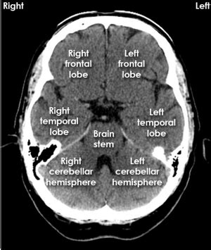 Brain Anatomy Lobes