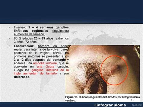 Linfogranuloma Venereo Ppt