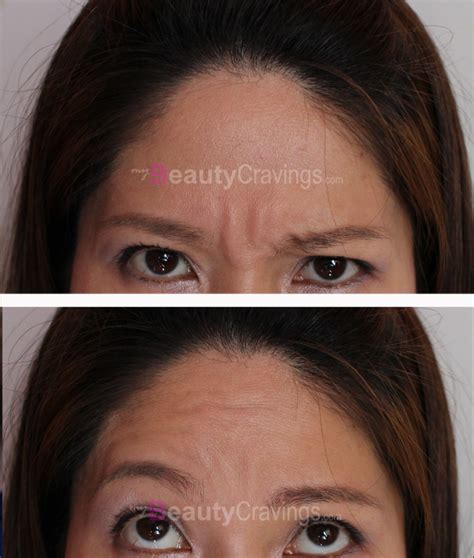 Botox Review at Cutis Medical Laser Clinics | $208 to get rid of Forehead Wrinkles ...