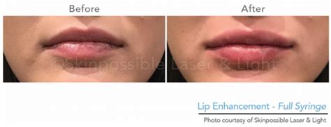 Lip Injections Dermapure Chaparral Formerly Skinpossible