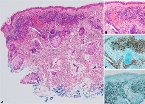 Representative images of a skin punch biopsy from the right... | Download Scientific Diagram