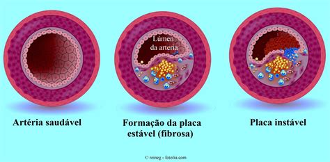 O que é aterosclerose Fisiopatologia e causas arteriosclerose