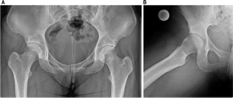 Anteroposterior A And Lateral B X Rays Of A Young Female Patient Download Scientific