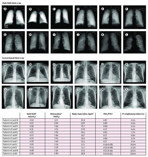 Dark Field Chest X Rays Conventional Chest X Rays Spirometry And Ct