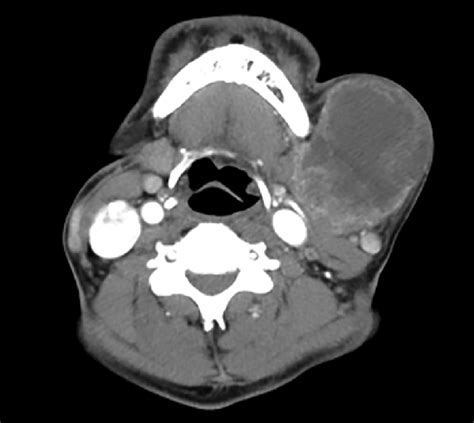 Computed Tomography Scan Neck Axial View Showing Lobulated Large Download Scientific Diagram