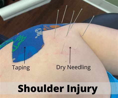 Shoulder Injury Susquehanna Spine And Rehab