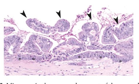 Figure 5 From Acute Torsion Of Appendicular Mucocele Semantic Scholar