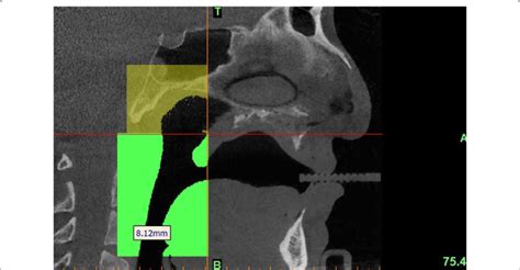 Outlining The Pharyngeal Airway Download Scientific Diagram