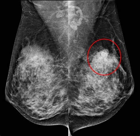 Mammogram Focal Asymmetry Radiology Cases