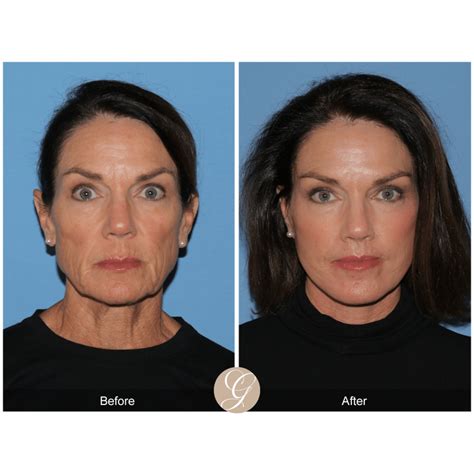 Preservation Facelift The Next Generation Of Deep Plane Facelift Technique