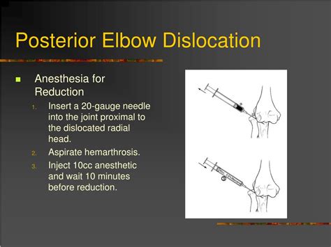 Ppt Dislocation And Fracture Reductions Powerpoint Presentation Free