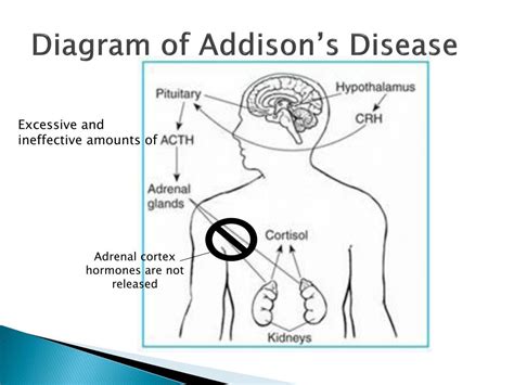 Ppt Addison’s Disease Powerpoint Presentation Free Download Id 1412672