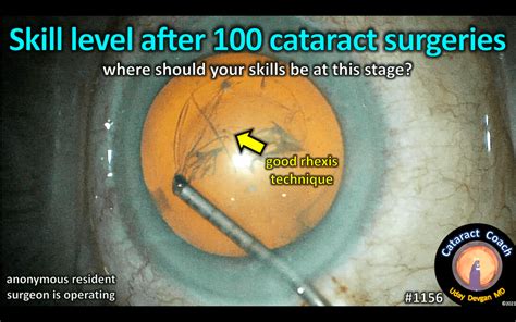 1156 Skill Level After 100 Cataract Cases Cataract Coach™