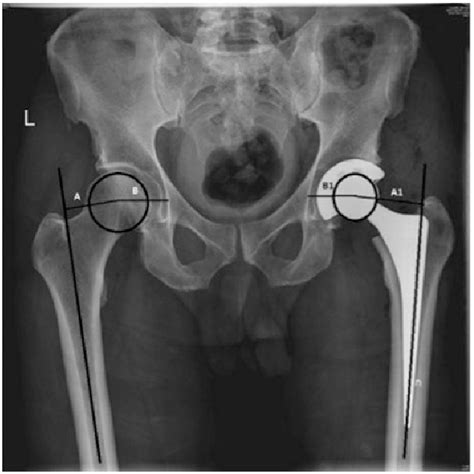 Postoperative Ap Pelvis Radiograph After Tha Using Uncemented Triology