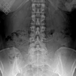 Radiographie Du Rachis Lombaire D Finition D Roulement Prise De