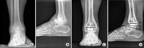 These Are Preoperative Anteroposterior A And Lateral B Radiographs Download Scientific