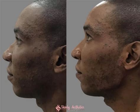 Jawline Fillers Before After Results At Skinly