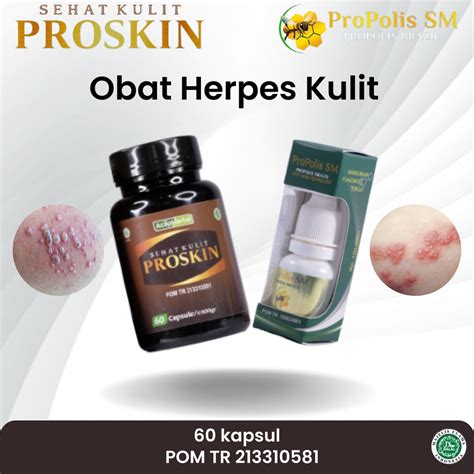 Jual Obat Herpes Penyakit Herpes Herpes Di Kelamin Herpes Zoster