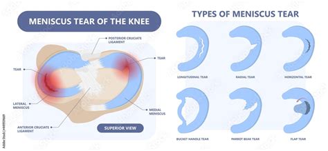 patella pain cap knee tear Torn injury Swelling bone leg exercise ...