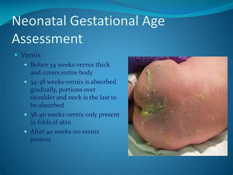 Ppt Neonatal Gestational Age Assessment Powerpoint Presentation Free